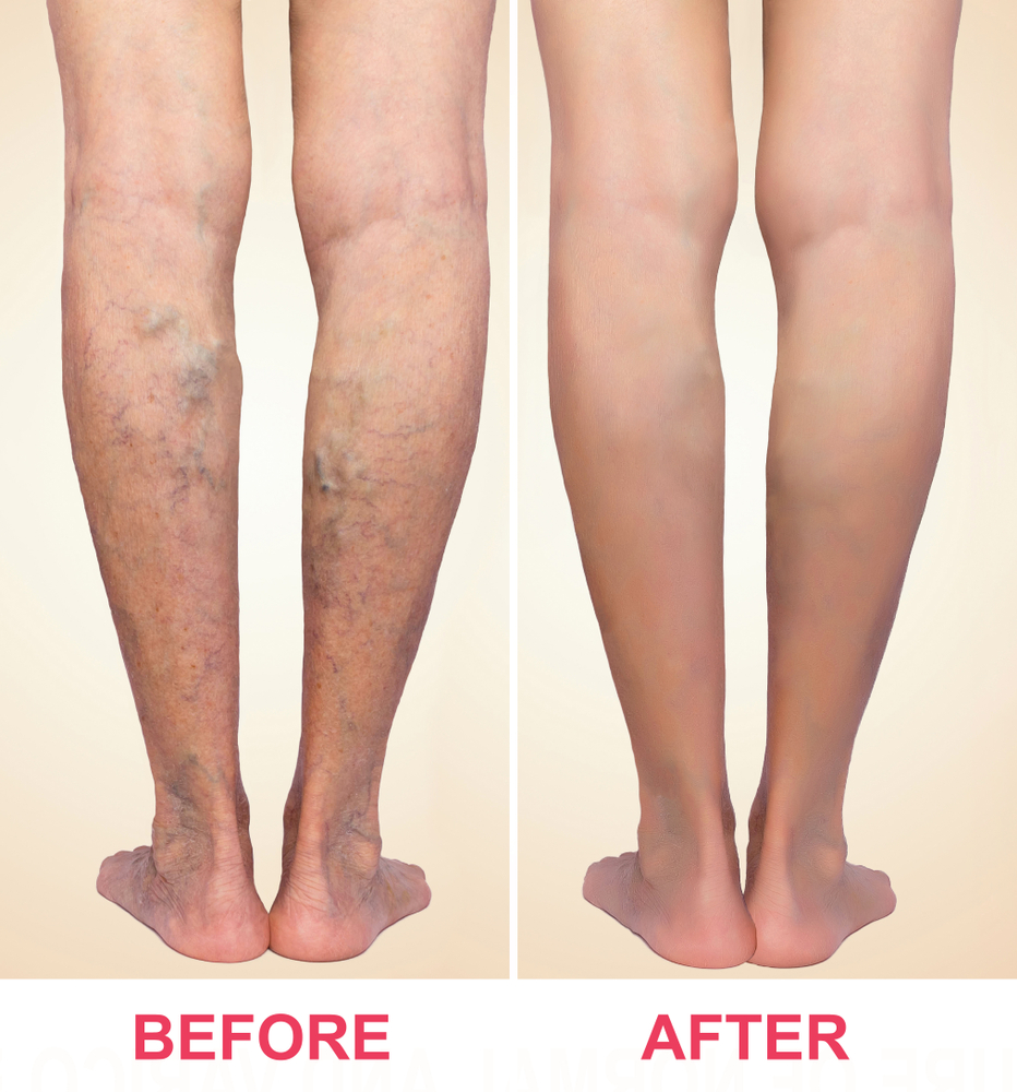 Varicose veins - before and after treatment