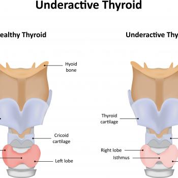 Underactive thyroid