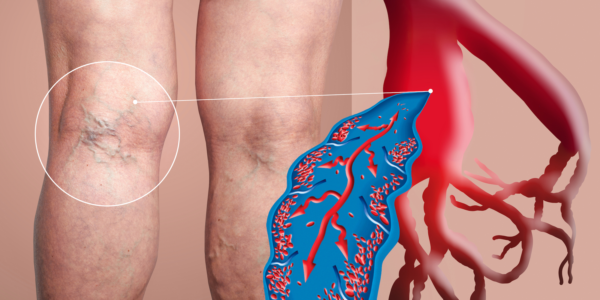 Varicoza consecinelor netraterii Netratarea varicelor poate provoca hemoragii fatale