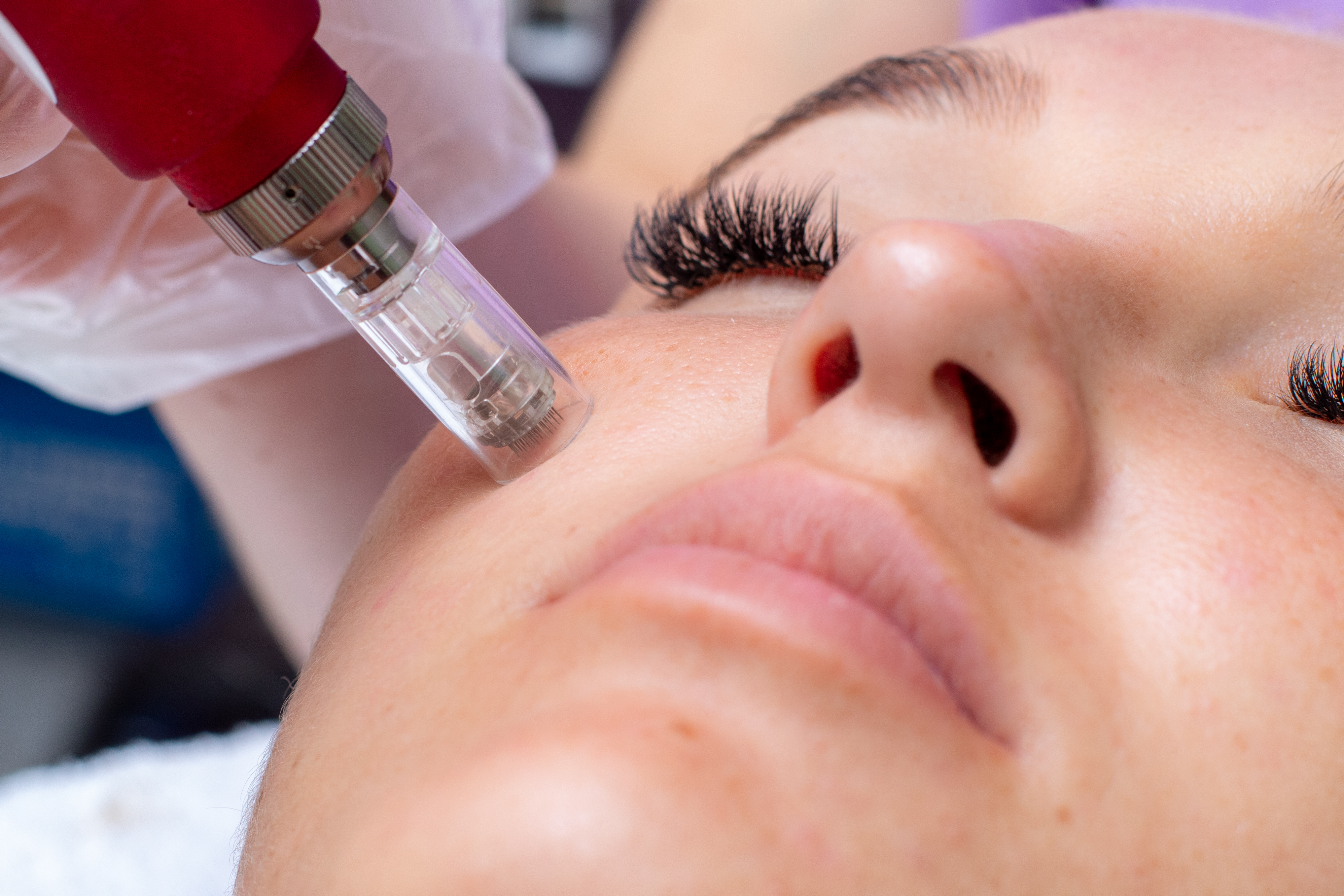 micro-needling