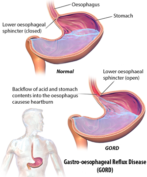 inside of stomach in GORD