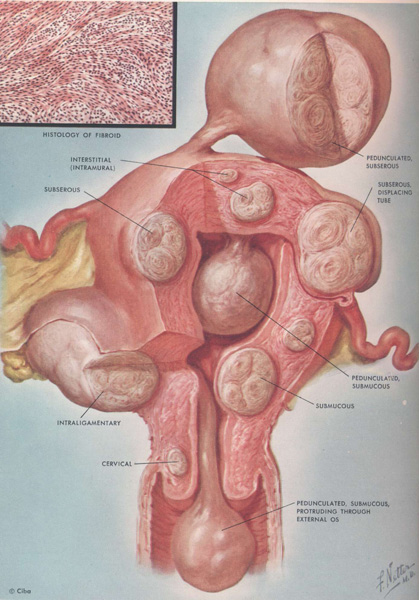 An Introduction to Fibroids | Total Health