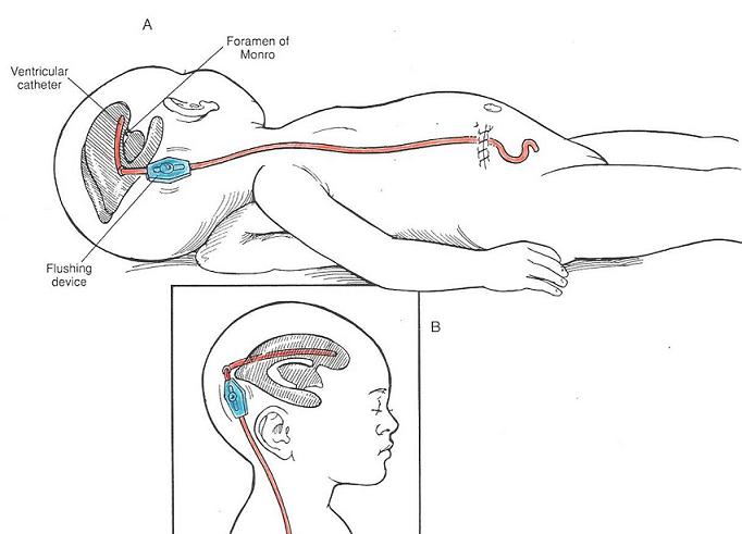 Гидроцефалия шунтирование мозга. Шунт при гидроцефалии схема. Шунт головного мозга при гидроцефалии. Шунтирование головы для вывода лишнего ликвора.