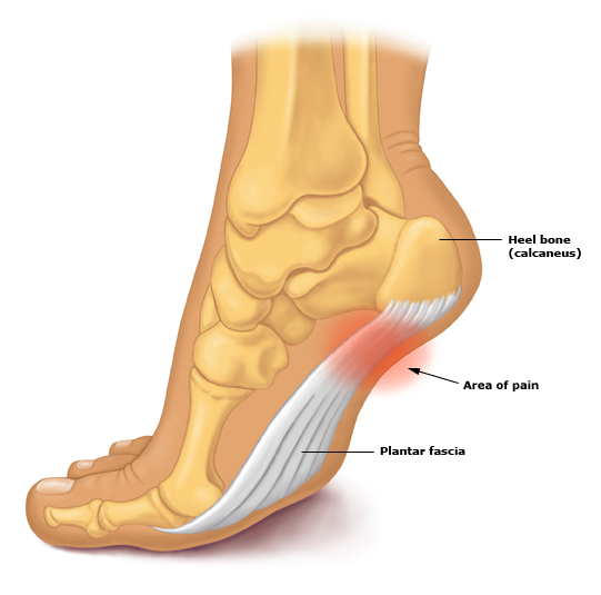 Symptoms, diagnosis and treatment of plantar fasciitis (heel pain ...