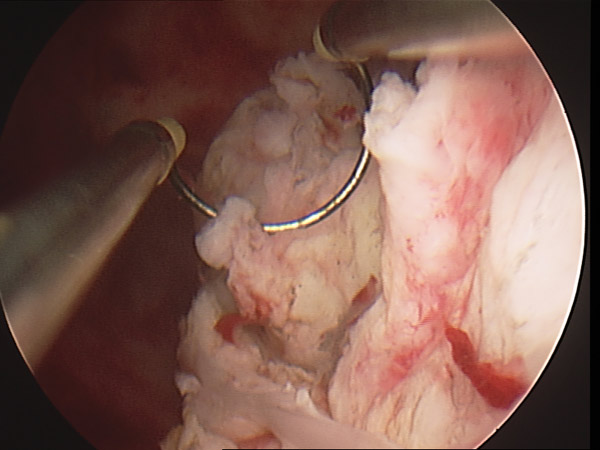 Modern Management of Uterine Fibroids | Total Health