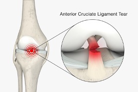 When the knee goes pop