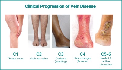 clinical progression of varicose veins