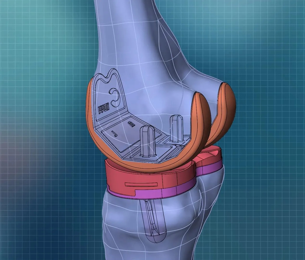Bespoke knee replacement