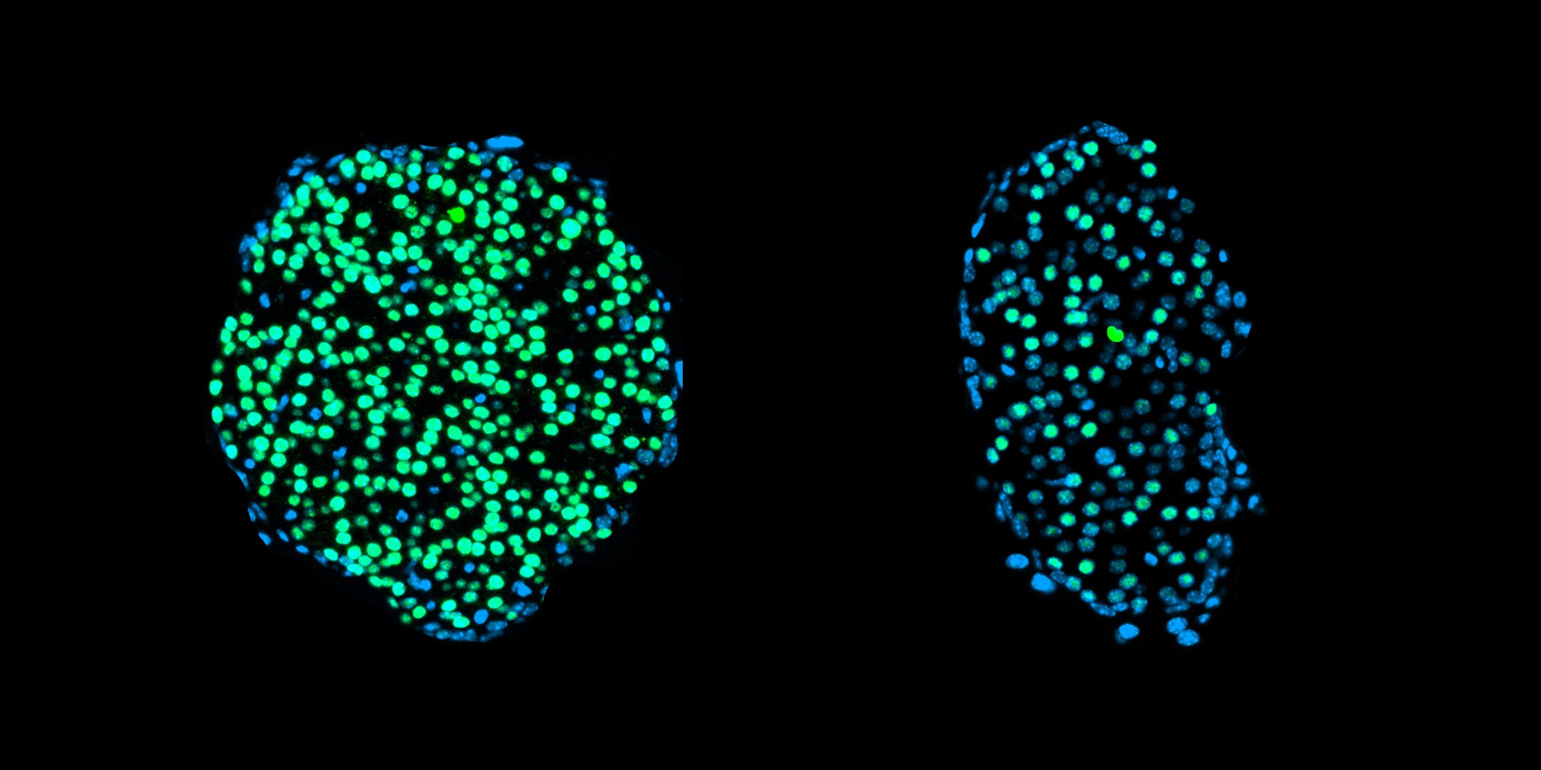 defective beta cells