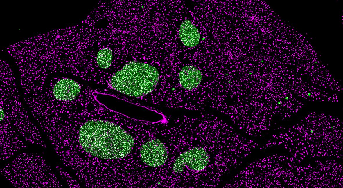 decline in beta cell function