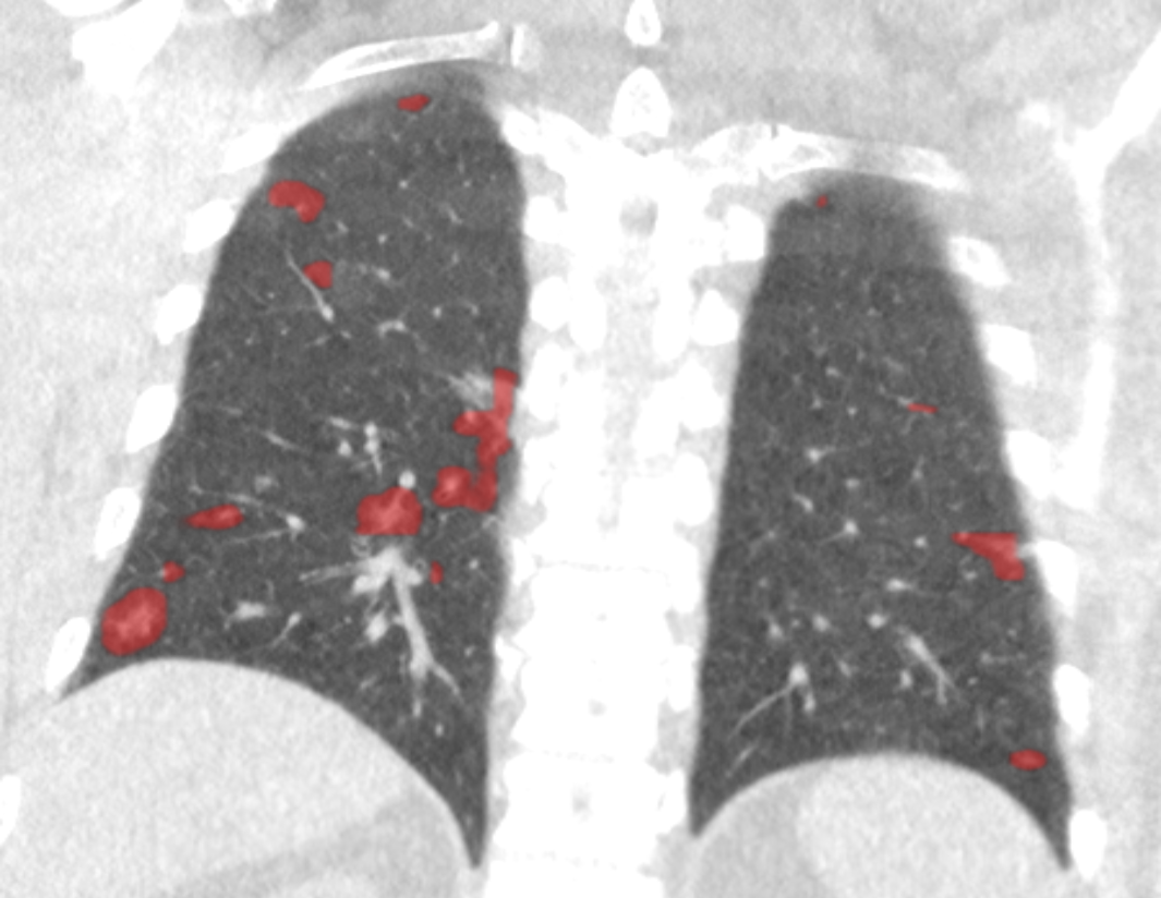 AI heat map scan