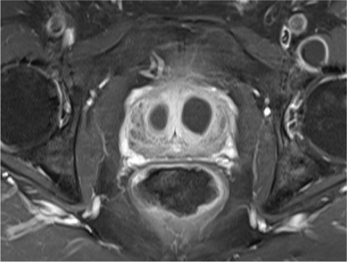 Prostate artery embolisation