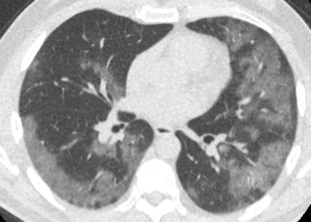 Regular CT scan from top