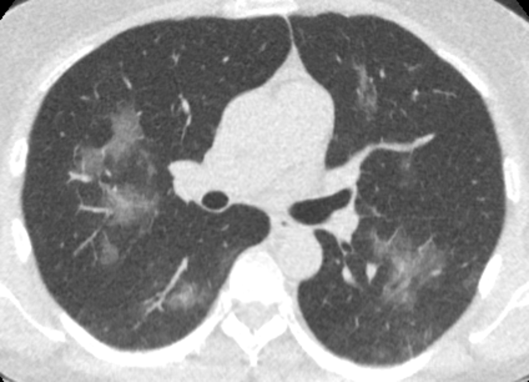 Regular CT scan non-AI