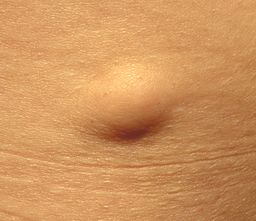 skin lipoma