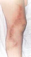 Thrombophlebitis