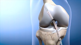 ACL reconstruction