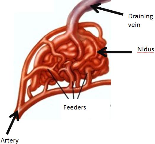 Diagram of an AVM