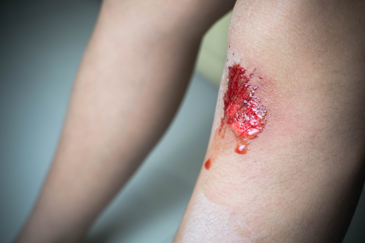 bleeding knee