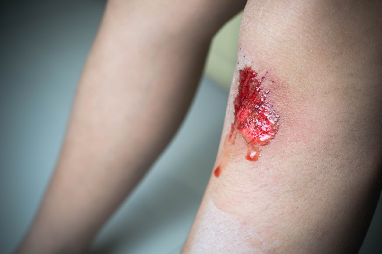 bleeding knee