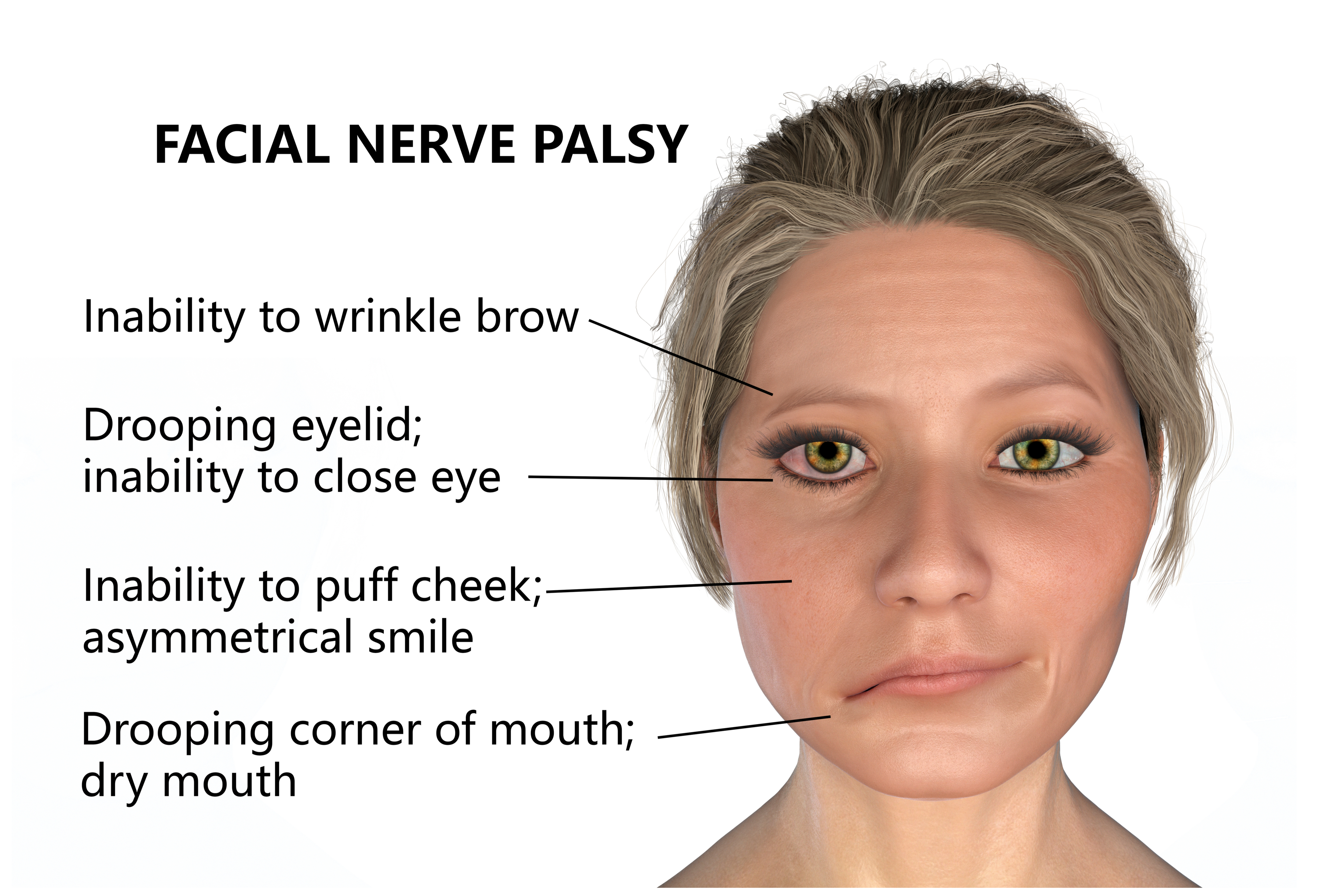 Bell's palsy symptoms