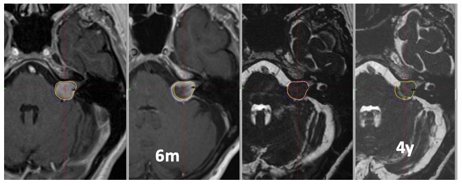 Tumour responding to gamma knife