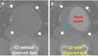 Comparing scans with and without contrast dye