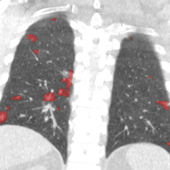 Acute lung infections