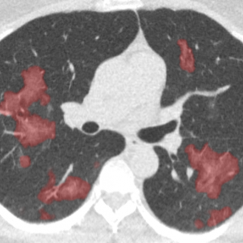 AI enhanced CT for COVID-19 infection analysis