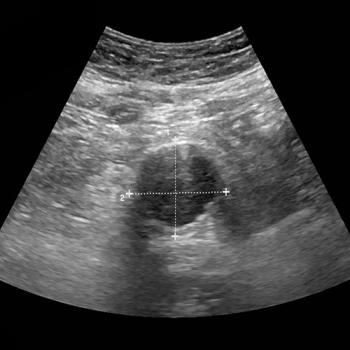 aaa screening scan