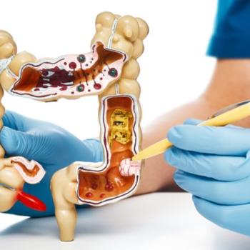 Detection and removal of polyps