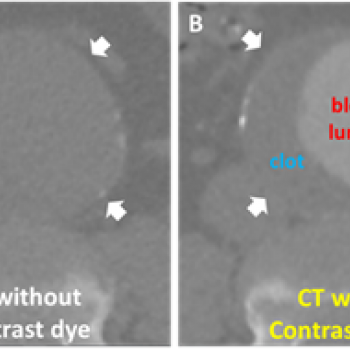 Replacing dangerous contrast dye